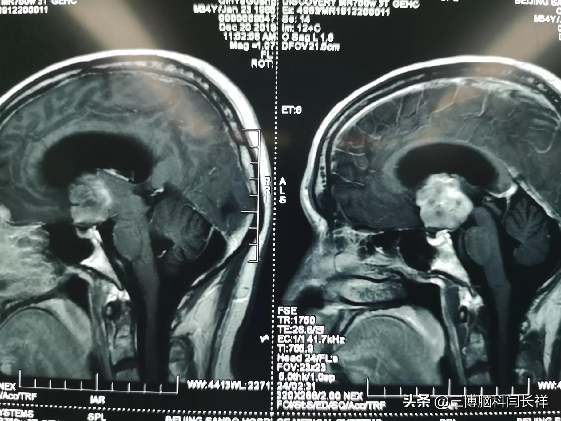 一位34歲的小夥11年前做的髓母細胞瘤手術