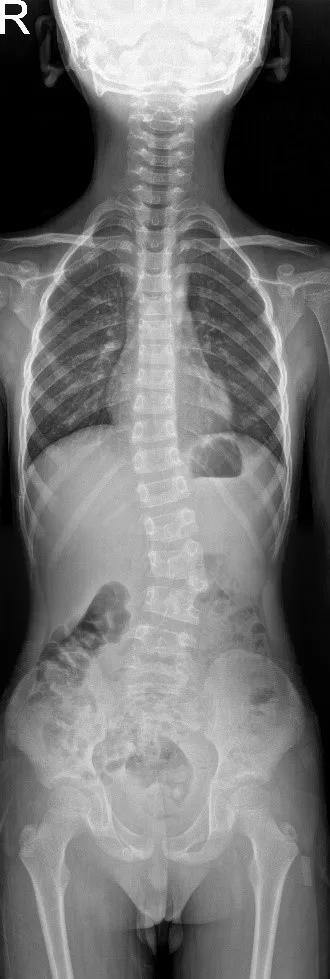 同济大学附属同济医院成功救治一例复杂儿童腰椎半椎体畸形