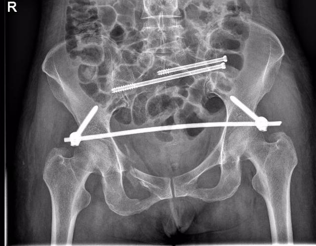 巧夺天工！潍坊市人民医院应用 STARR 架微创精准治疗复杂骨盆骨折
