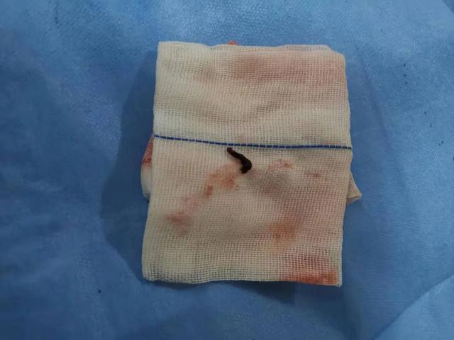 【关注】72 岁张大伯突发中风，紧急转院，老伴在手术室前说出了这句